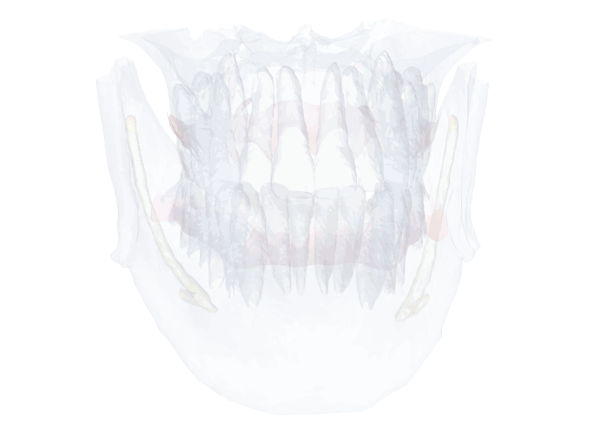 Mandíbula e maxila segmentadas em 3D com o escaneamento intraoral sobreposto