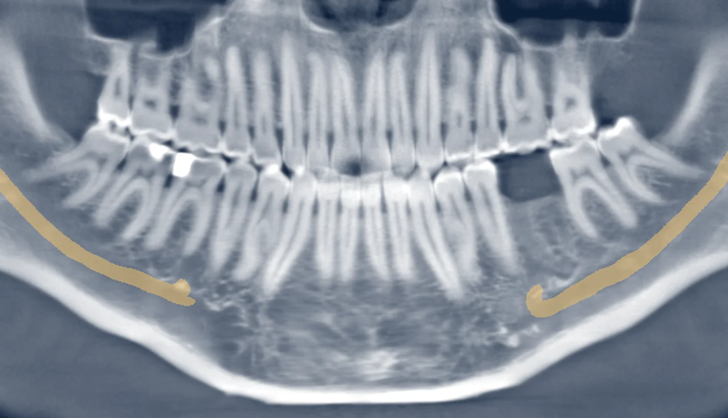 Radiografia panorâmica gerada da mesma tomografia, com os dentes numerados